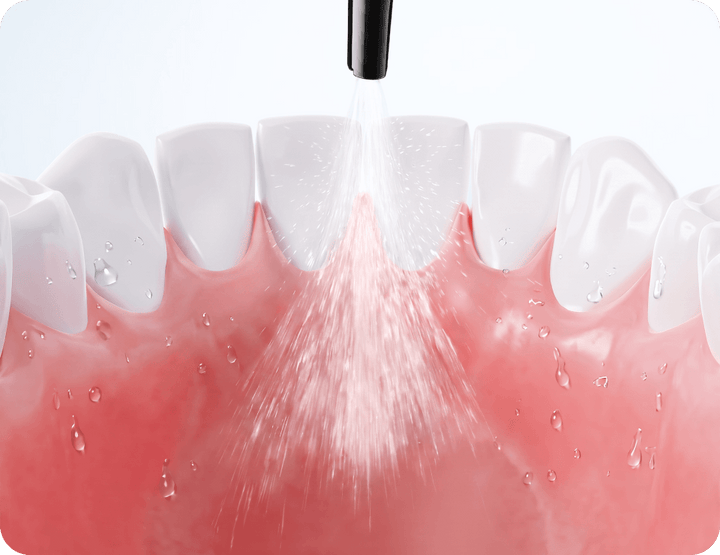 Whole-mouth plaque removal