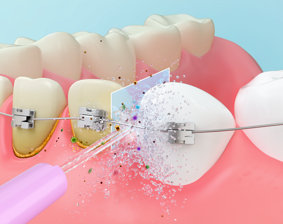 Water flosser cleaning teeth with braces, oral hygiene