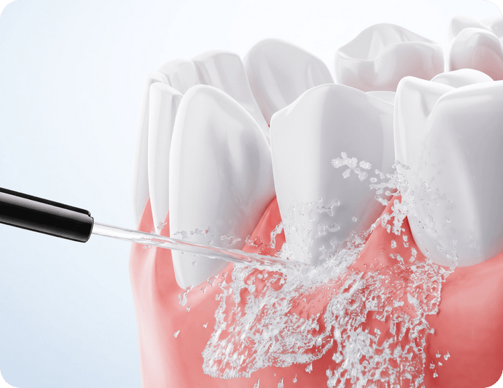 Gumline plaque removal